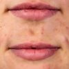 CurrentBody LED Lip Plumping Device Softening Lines-4
